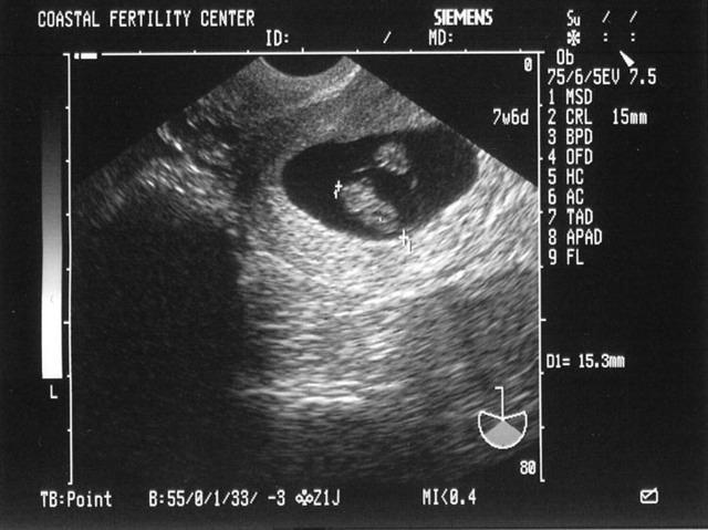 5/10/05
Baby B - 7w6d