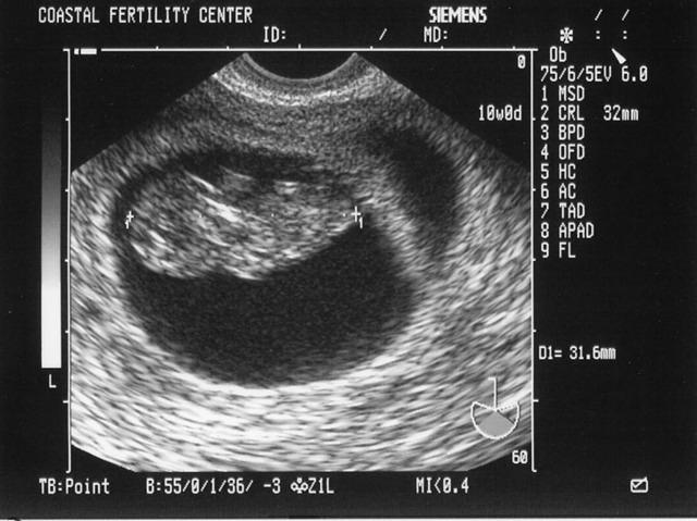 5/23/05
Baby A - 10w0d