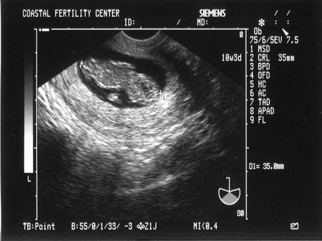 5/28/05
Baby B - 10w3d