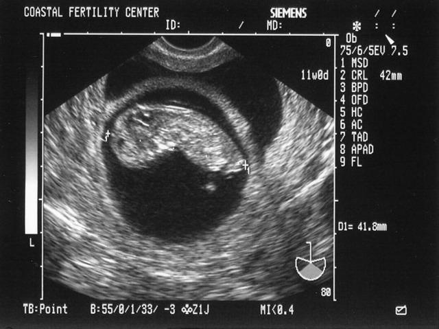 5/28/05
Baby A - 11w0d