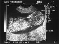 Ultrasounds