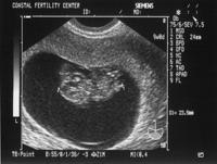 5/17/05
Baby A - 9w0d