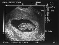 5/17/05
Baby B - 8w6d