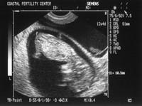 6/7/05
Baby B - 12w4d